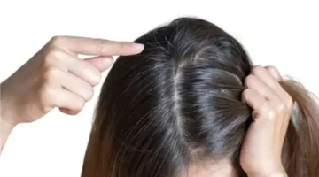 وصفة هاني الناظر الطبيعية لعلاج تساقط الشعر بكشف نجل خبير الجلدية